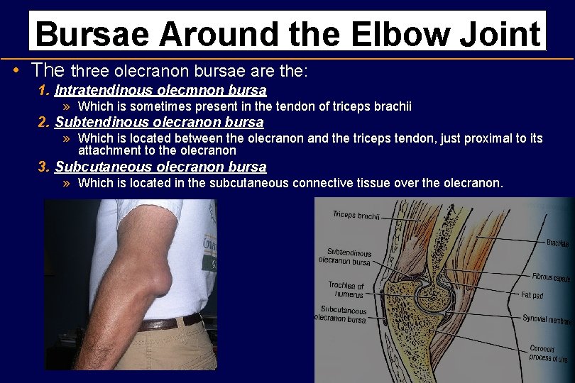 Bursae Around the Elbow Joint • The three olecranon bursae are the: 1. Intratendinous