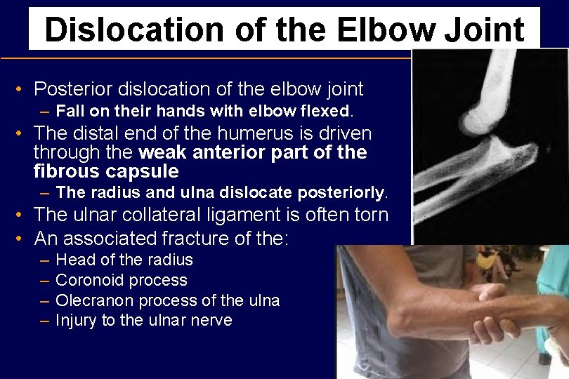 Dislocation of the Elbow Joint • Posterior dislocation of the elbow joint – Fall
