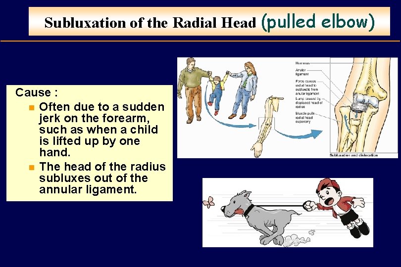 Subluxation of the Radial Head (pulled elbow) Cause : n Often due to a