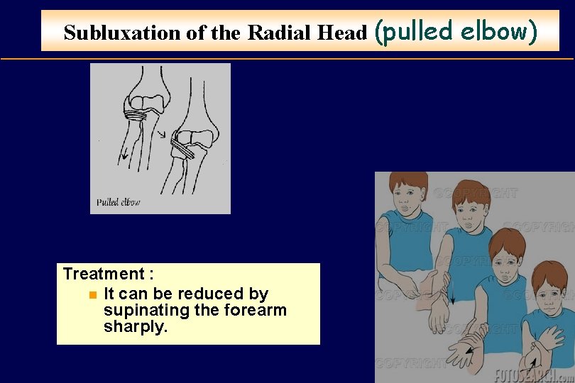 Subluxation of the Radial Head (pulled elbow) Treatment : n It can be reduced