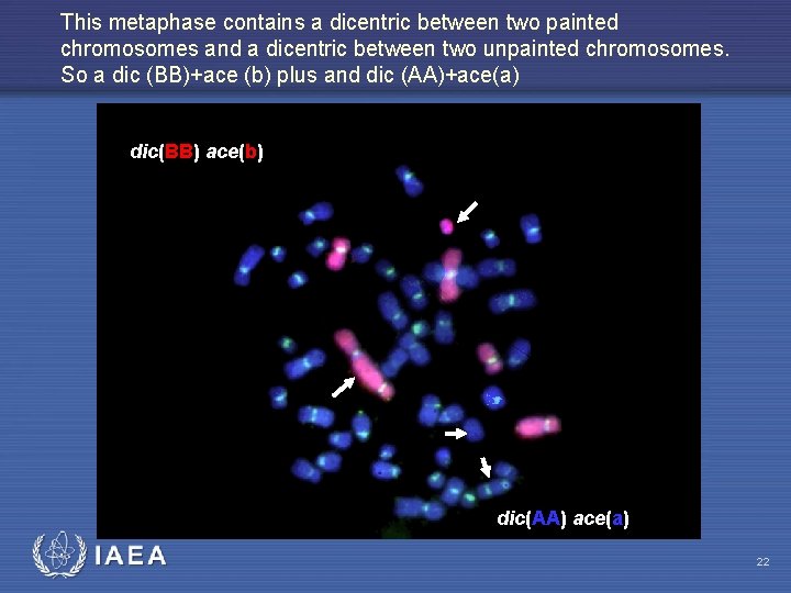 This metaphase contains a dicentric between two painted chromosomes and a dicentric between two
