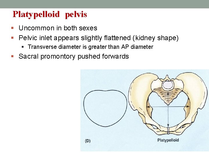 Platypelloid pelvis § Uncommon in both sexes § Pelvic inlet appears slightly flattened (kidney