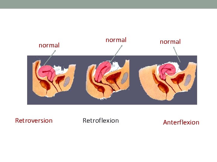 normal Retroversion normal Retroflexion normal Anterflexion 