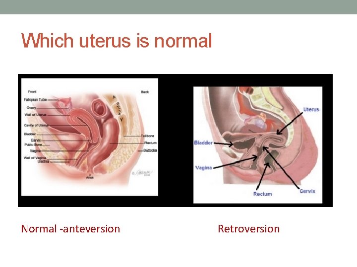 Which uterus is normal Normal -anteversion Retroversion 