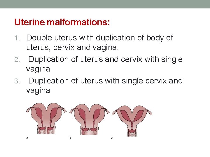 Uterine malformations: 1. Double uterus with duplication of body of uterus, cervix and vagina.
