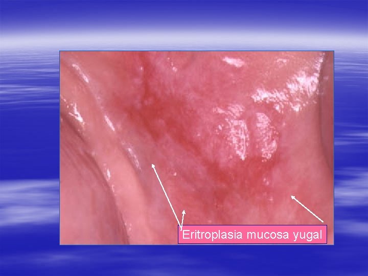 Eritroplasia mucosa yugal 