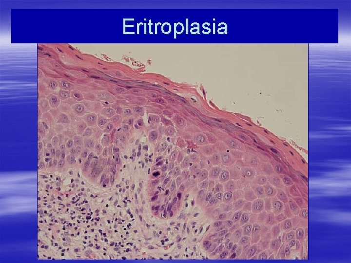 Eritroplasia 