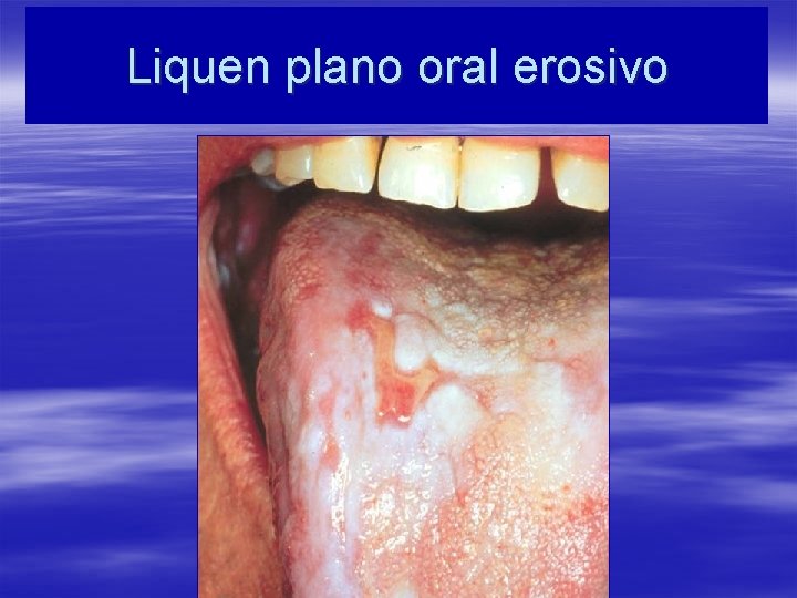 Liquen plano oral erosivo 