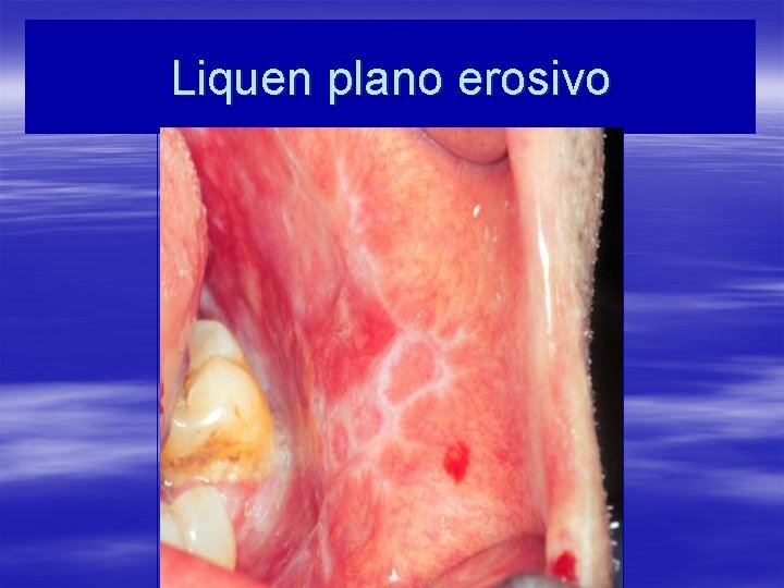 Liquen plano erosivo 
