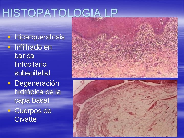 HISTOPATOLOGIA LP § Hiperqueratosis § Infiltrado en banda linfocitario subepitelial § Degeneración hidrópica de