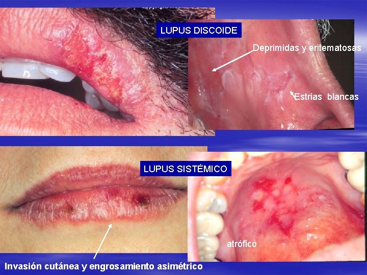 LUPUS DISCOIDE Deprimidas y eritematosas Estrias blancas LUPUS SISTÉMICO atrófico Invasión cutánea y engrosamiento