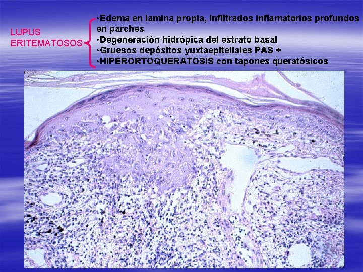 LUPUS ERITEMATOSOS • Edema en lamina propia, Infiltrados inflamatorios profundos en parches • Degeneración