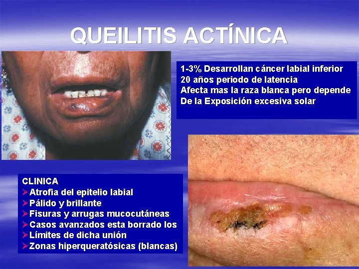 QUEILITIS ACTÍNICA 1 -3% Desarrollan cáncer labial inferior 20 años periodo de latencia Afecta