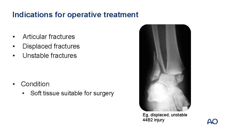 Indications for operative treatment • • • Articular fractures Displaced fractures Unstable fractures •