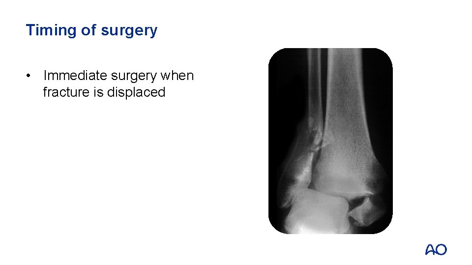 Timing of surgery • Immediate surgery when fracture is displaced 