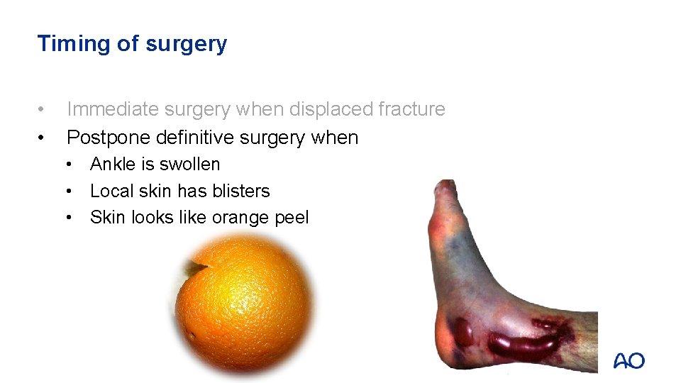 Timing of surgery • • Immediate surgery when displaced fracture Postpone definitive surgery when