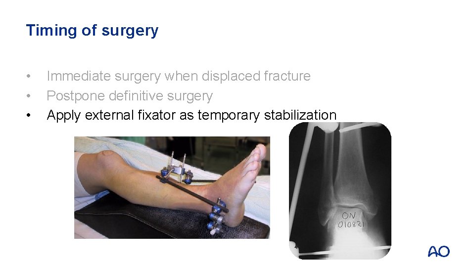 Timing of surgery • • • Immediate surgery when displaced fracture Postpone definitive surgery