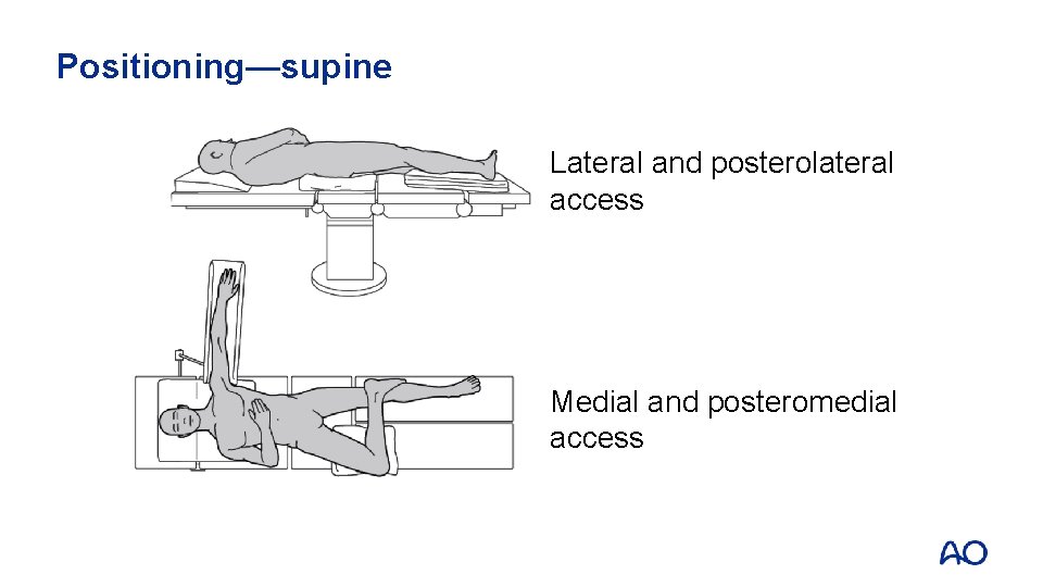 Positioning—supine Lateral and posterolateral access Medial and posteromedial access 