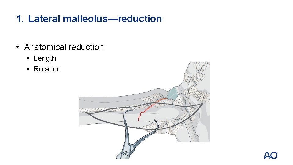 1. Lateral malleolus—reduction • Anatomical reduction: • Length • Rotation 