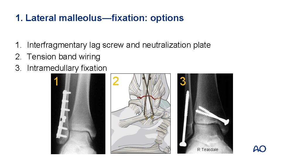 1. Lateral malleolus—fixation: options 1. Interfragmentary lag screw and neutralization plate 2. Tension band