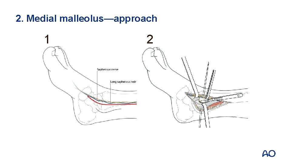 2. Medial malleolus—approach 1 2 