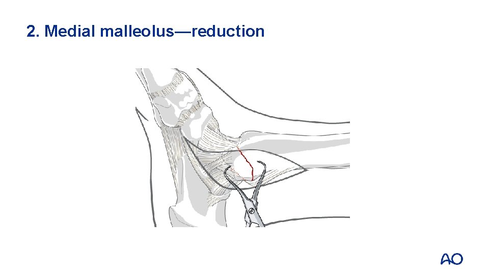 2. Medial malleolus—reduction 