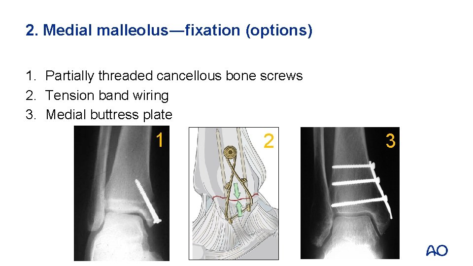 2. Medial malleolus―fixation (options) 1. Partially threaded cancellous bone screws 2. Tension band wiring