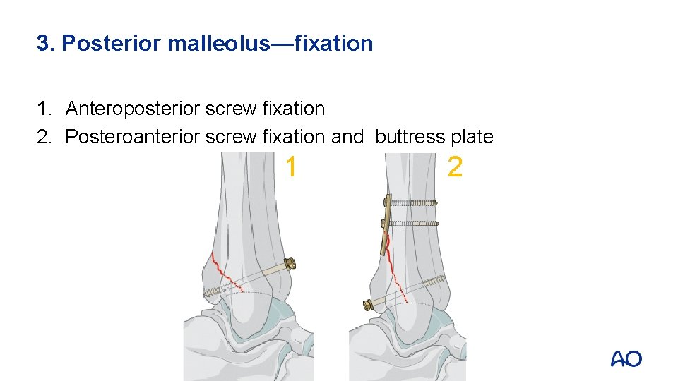3. Posterior malleolus—fixation 1. Anteroposterior screw fixation 2. Posteroanterior screw fixation and buttress plate