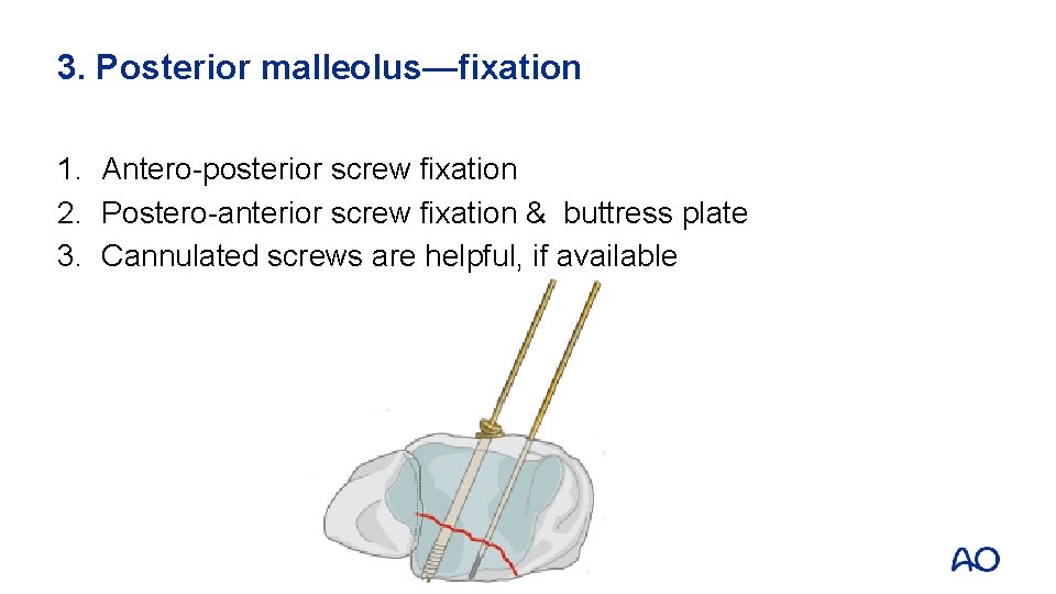 3. Posterior malleolus—fixation 1. Antero-posterior screw fixation 2. Postero-anterior screw fixation & buttress plate