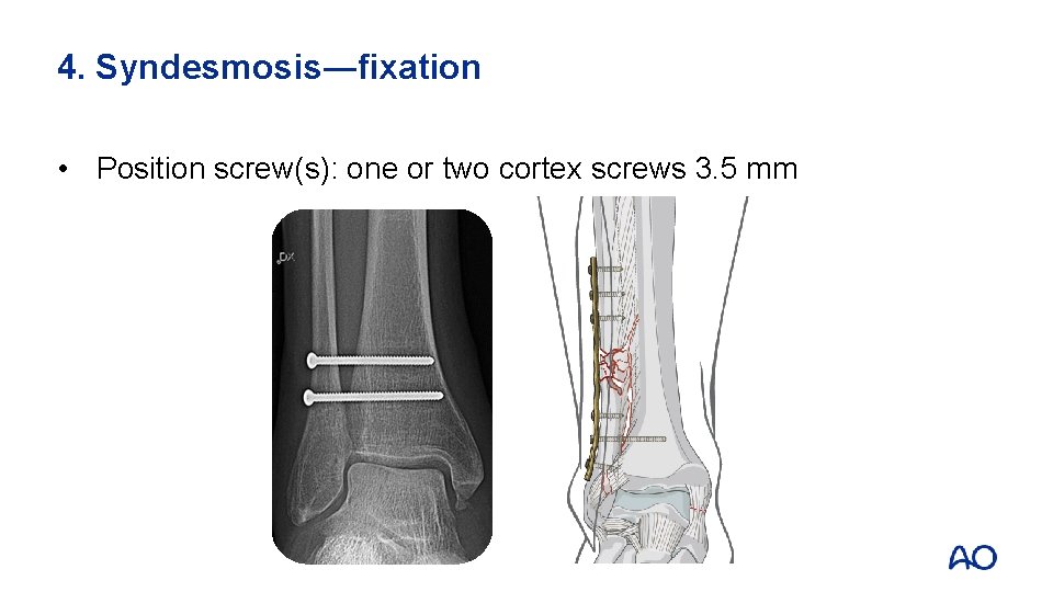 4. Syndesmosis―fixation • Position screw(s): one or two cortex screws 3. 5 mm 