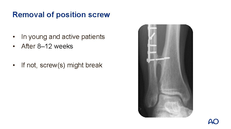 Removal of position screw • In young and active patients • After 8– 12
