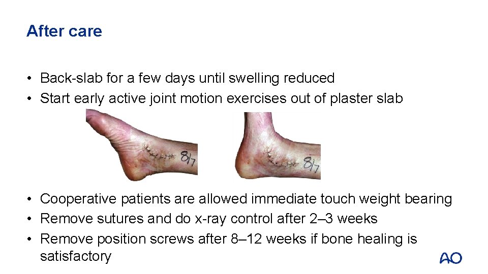 After care • Back-slab for a few days until swelling reduced • Start early