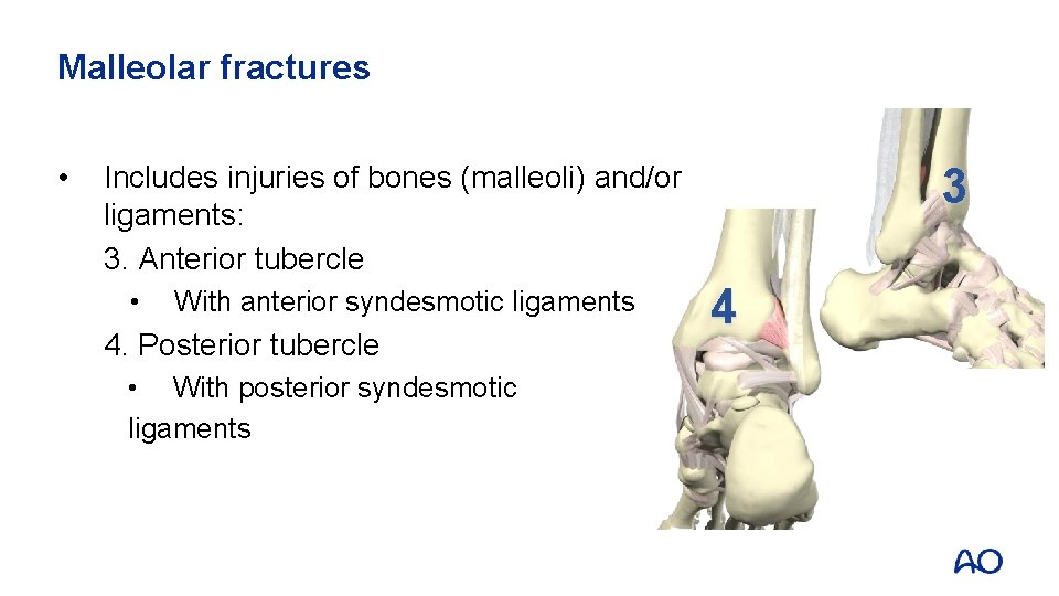 Malleolar fractures • 3 Includes injuries of bones (malleoli) and/or ligaments: 3. Anterior tubercle