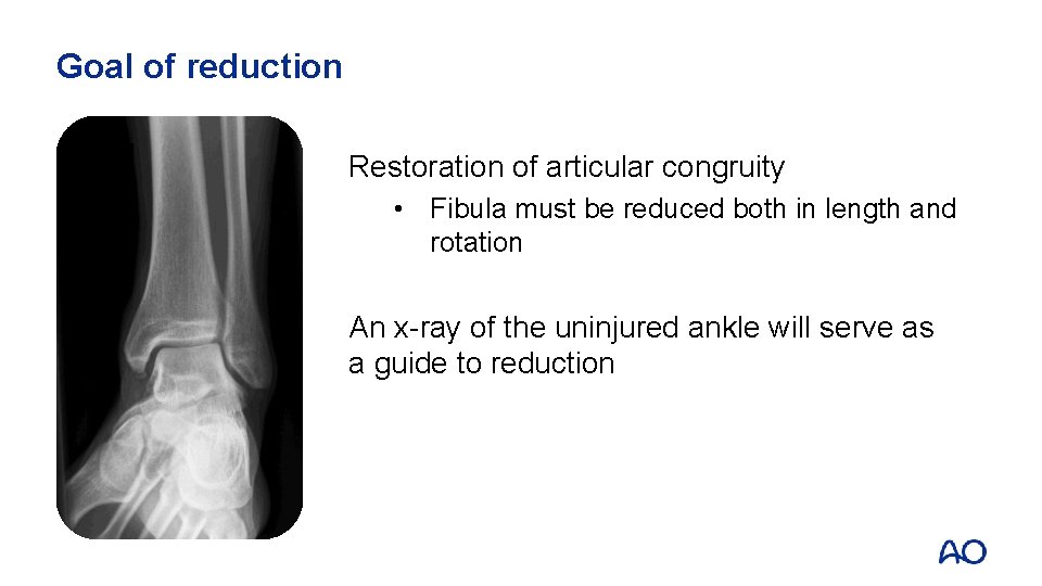 Goal of reduction Restoration of articular congruity • Fibula must be reduced both in