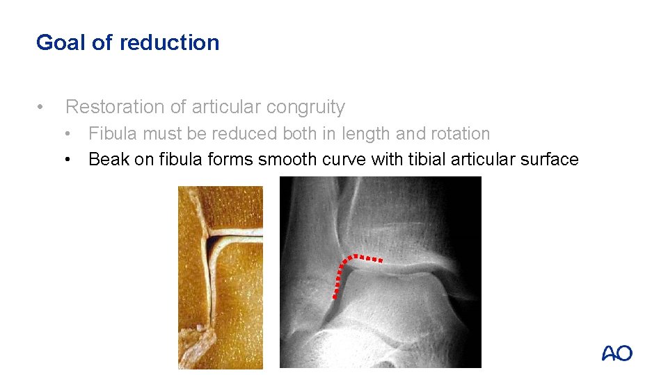 Goal of reduction • Restoration of articular congruity • Fibula must be reduced both