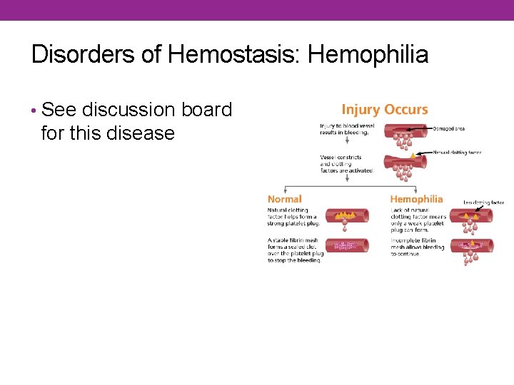 Disorders of Hemostasis: Hemophilia • See discussion board for this disease 