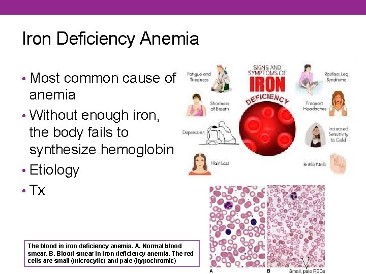Iron Deficiency Anemia • Most common cause of anemia • Without enough iron, the