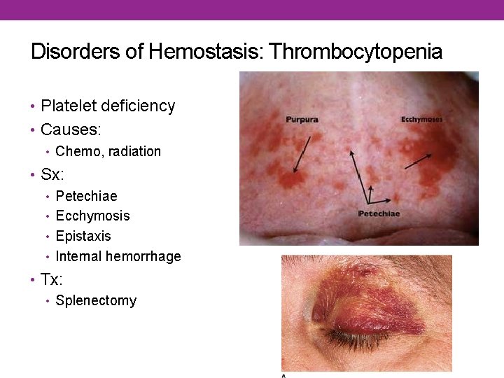 Disorders of Hemostasis: Thrombocytopenia • Platelet deficiency • Causes: • Chemo, radiation • Sx: