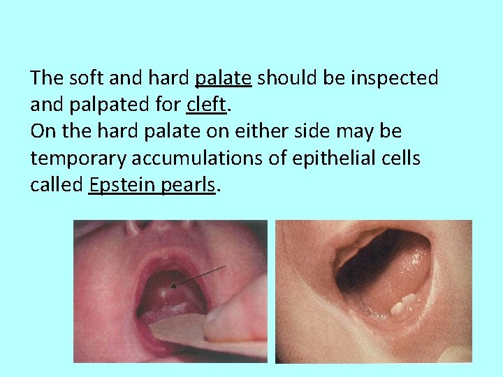 The soft and hard palate should be inspected and palpated for cleft. On the