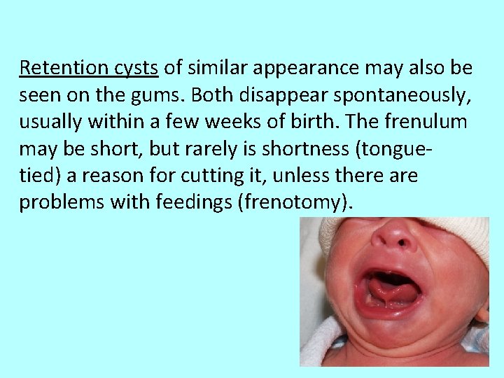 Retention cysts of similar appearance may also be seen on the gums. Both disappear