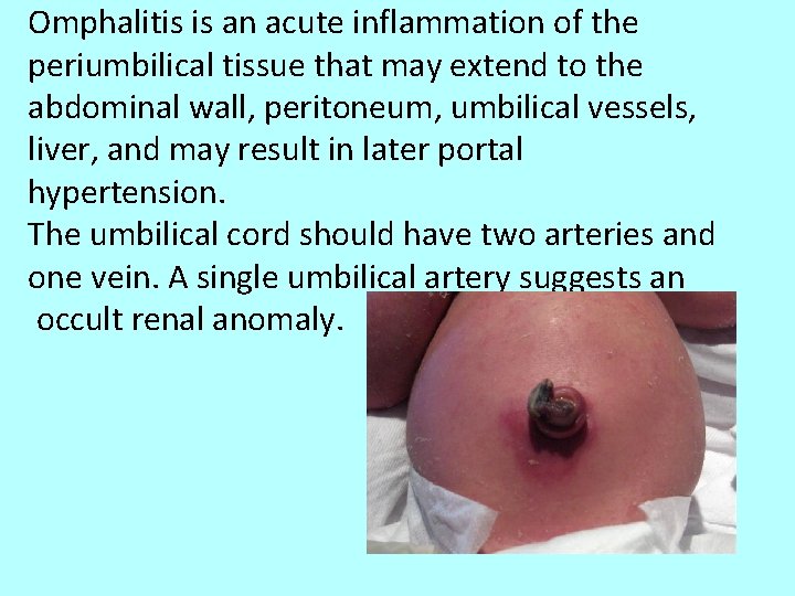 Omphalitis is an acute inflammation of the periumbilical tissue that may extend to the