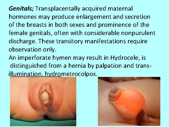 Genitals; Transplacentally acquired maternal hormones may produce enlargement and secretion of the breasts in