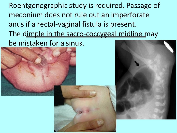 Roentgenographic study is required. Passage of meconium does not rule out an imperforate anus