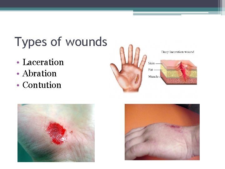 Types of wounds • Laceration • Abration • Contution 