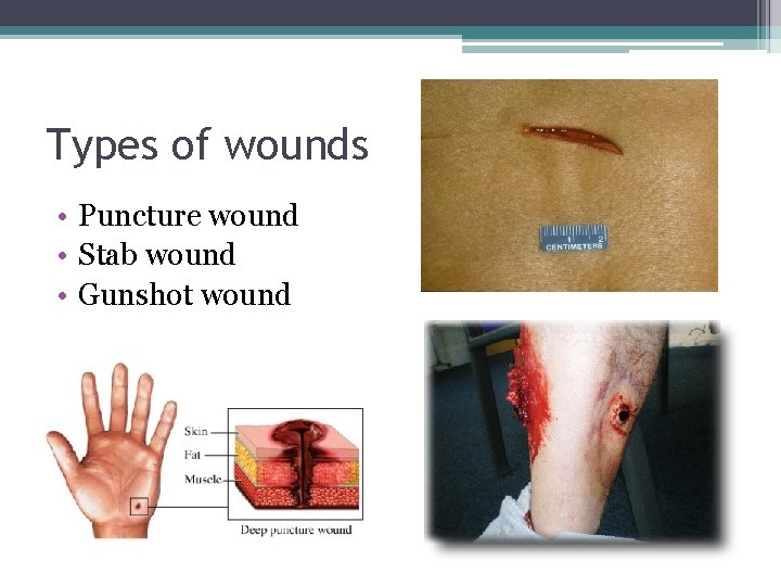 Types of wounds • Puncture wound • Stab wound • Gunshot wound 