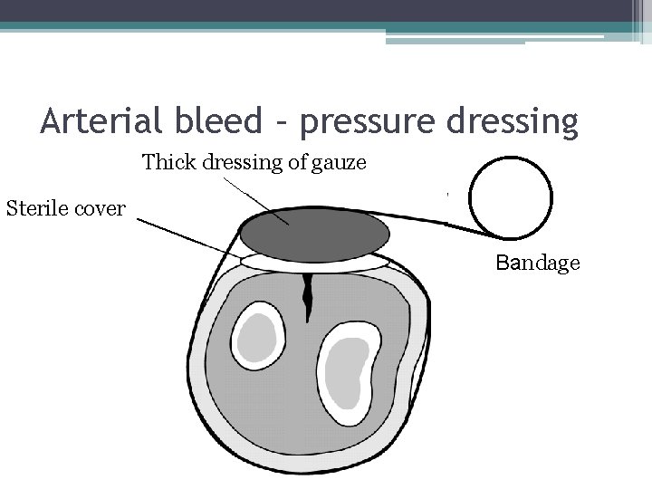 Arterial bleed – pressure dressing Thick dressing of gauze Sterile cover Bandage 