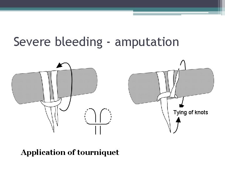 Severe bleeding - amputation Tying of knots Application of tourniquet 