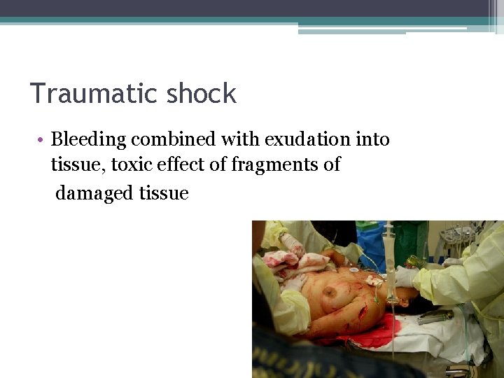 Traumatic shock • Bleeding combined with exudation into tissue, toxic effect of fragments of