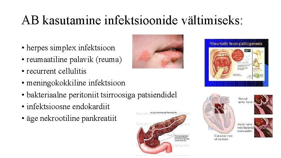 AB kasutamine infektsioonide vältimiseks: • herpes simplex infektsioon • reumaatiline palavik (reuma) • recurrent