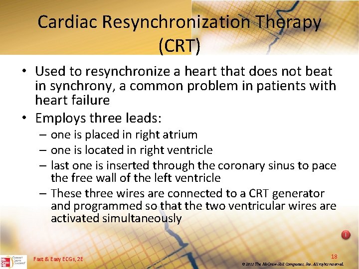 Cardiac Resynchronization Therapy (CRT) • Used to resynchronize a heart that does not beat